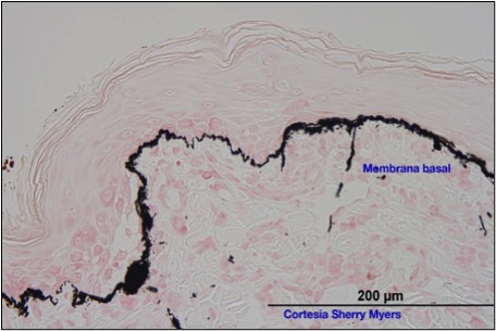 Observe la mineralización( negra) de la membrana basal, vea que es muy difícil distinguirla con la tinción de HE.
