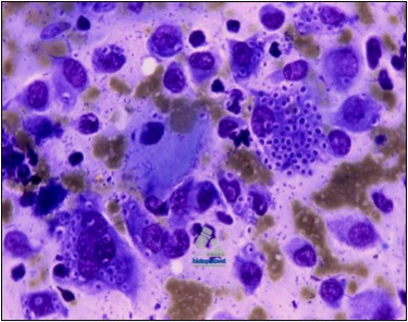 En infecciosas. HISTOPLASMOSIS CUTÁNEA. Observe que el hongo se ve dentro del macrófago. También, la técnica permite ver bacterias, fuera de las células.